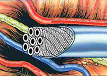 Лечение лимфедемы